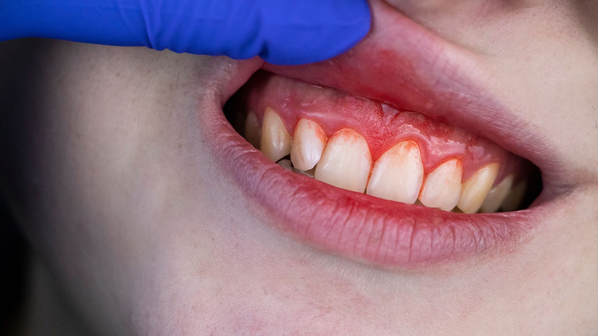 gingivitt